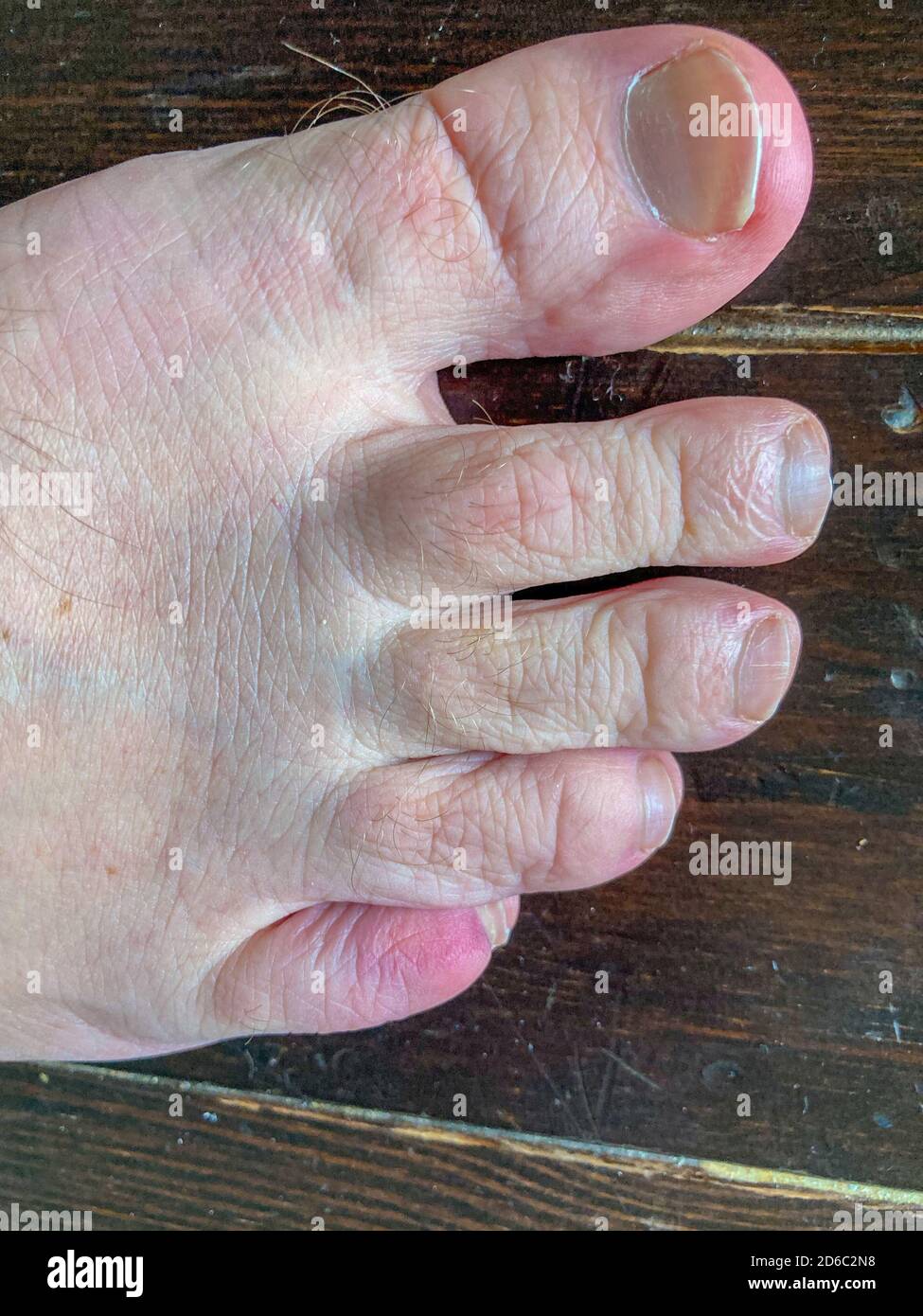 Bruised fractured little toe of a man in close up over a wooden deck as a result of blunt force trauma Stock Photo