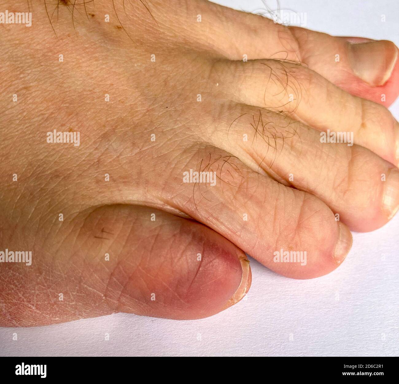 Discolored broken little toe of a senior man in close up as a result of blunt force trauma in a healthcare concept Stock Photo