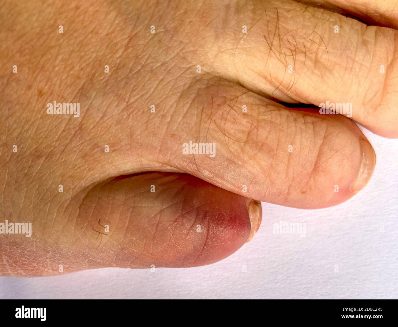 Discolored broken little toe of a senior man in close up as a result of blunt force trauma in a healthcare concept Stock Photo