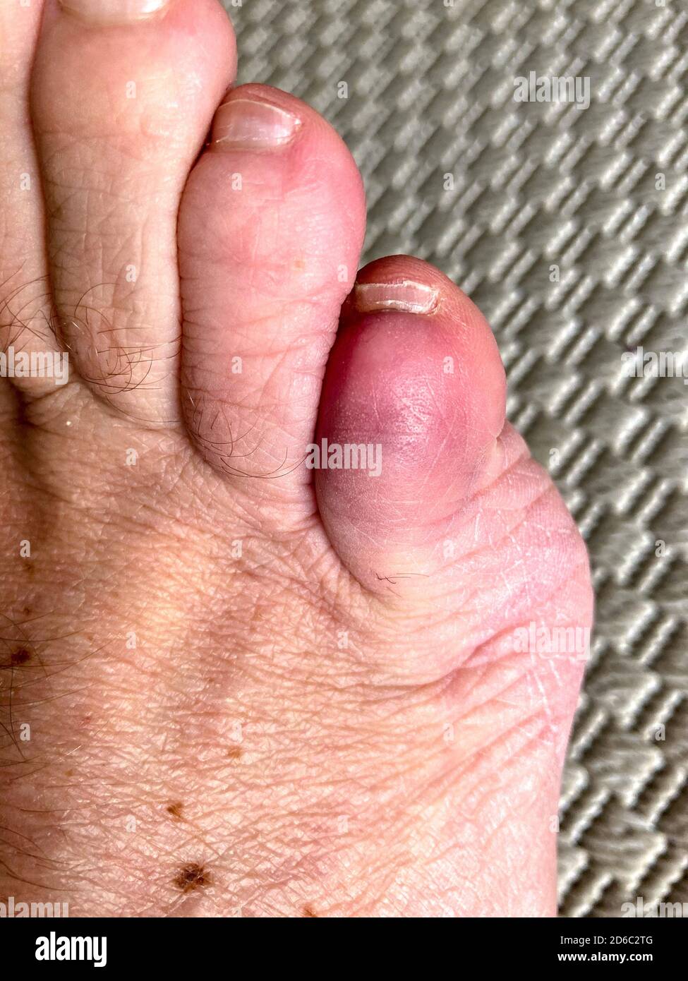 Bruised Toe High Resolution Stock Photography And Images Alamy