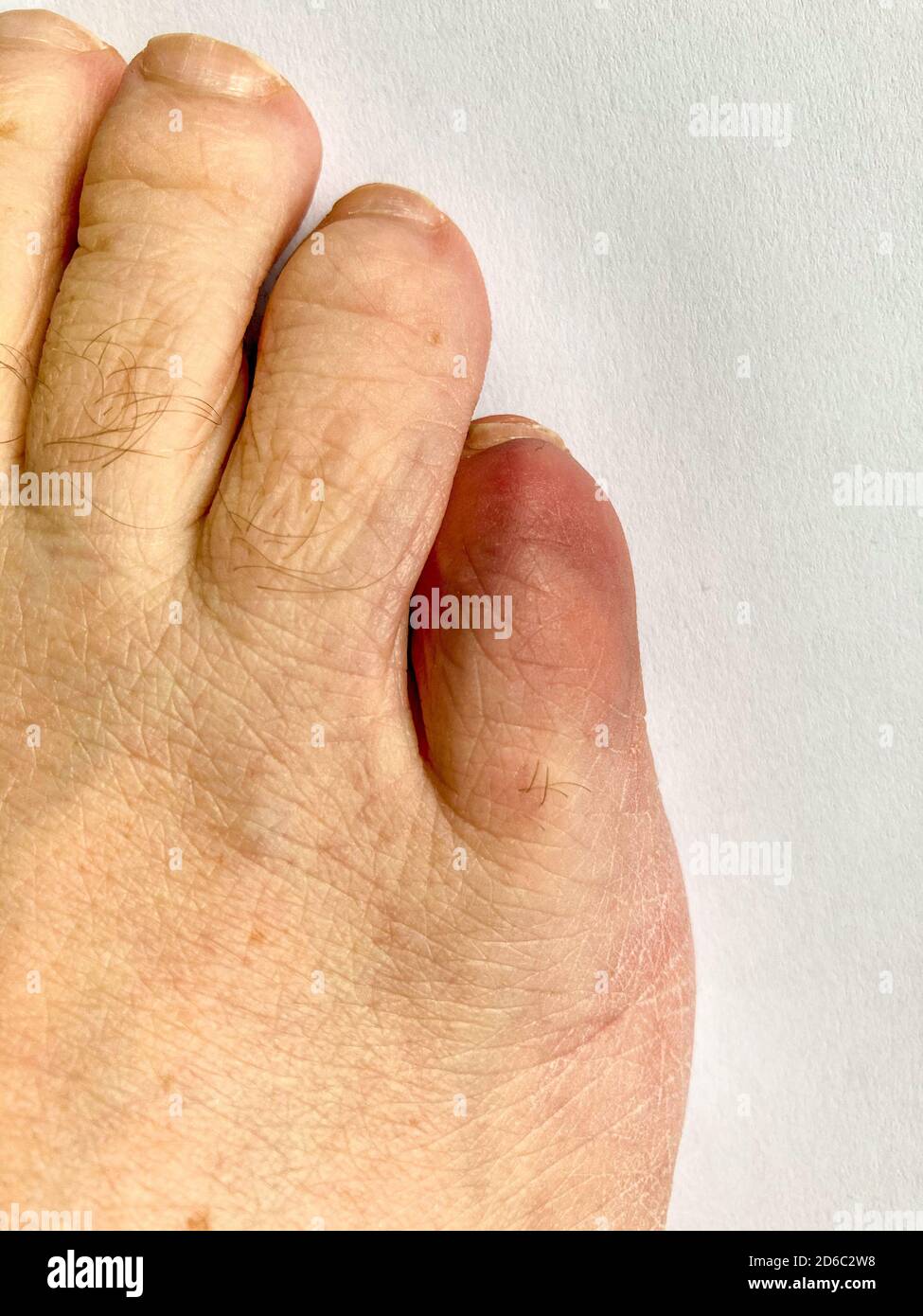 Close up on the broken little toe of a senior man showing discoloration at the site of the trauma viewed top down Stock Photo