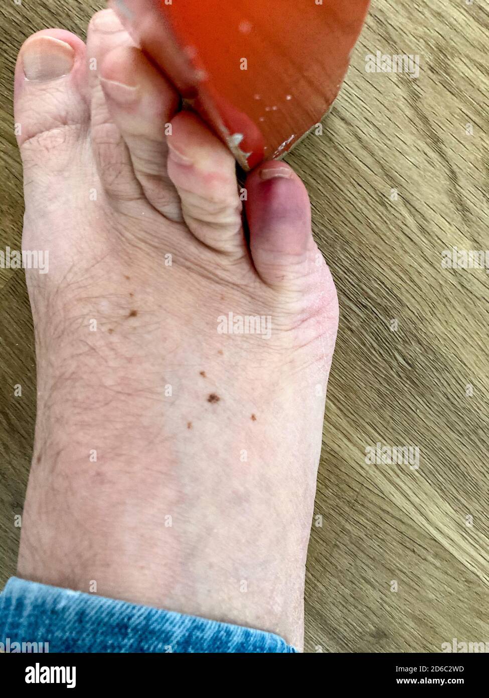 Blunt force trauma to the foot of a senior man resulting in a broken or fractured little toe and discoloration of the tissue viewed from above Stock Photo