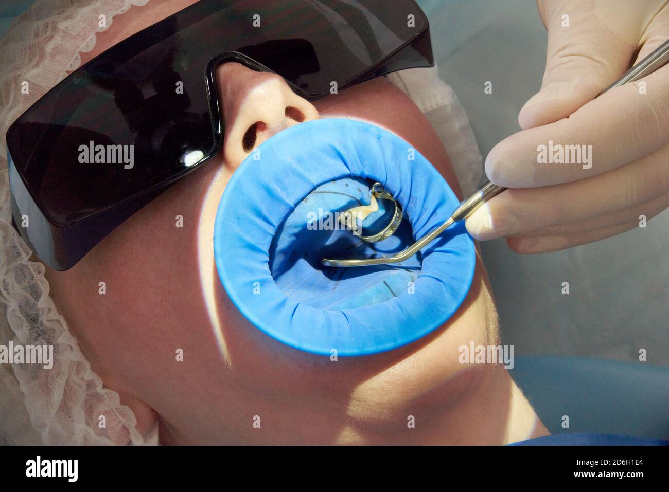 Patient getting dental treatment at dentist office with dental rubber
