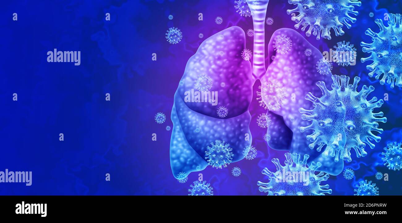 Lungs virus and respiratory infection or coronavirus outbreak and covid-19 or influenza as a flu strain case or SARS as a pandemic medical health. Stock Photo