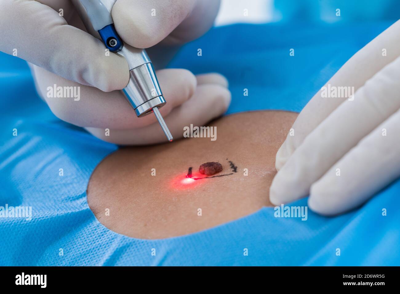 Exeresis of a nevus (mole) using a CO2 surgical laser, Center Cosem Paris. Stock Photo