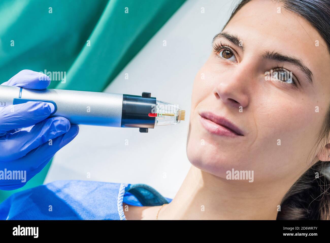 Picture of Precision and high intensity radiofrequency treatment, used to reduce ...