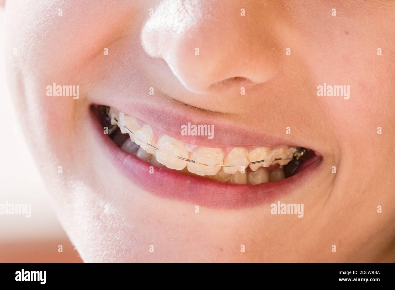 Teenager with fixed braces on her teeth Stock Photo Alamy