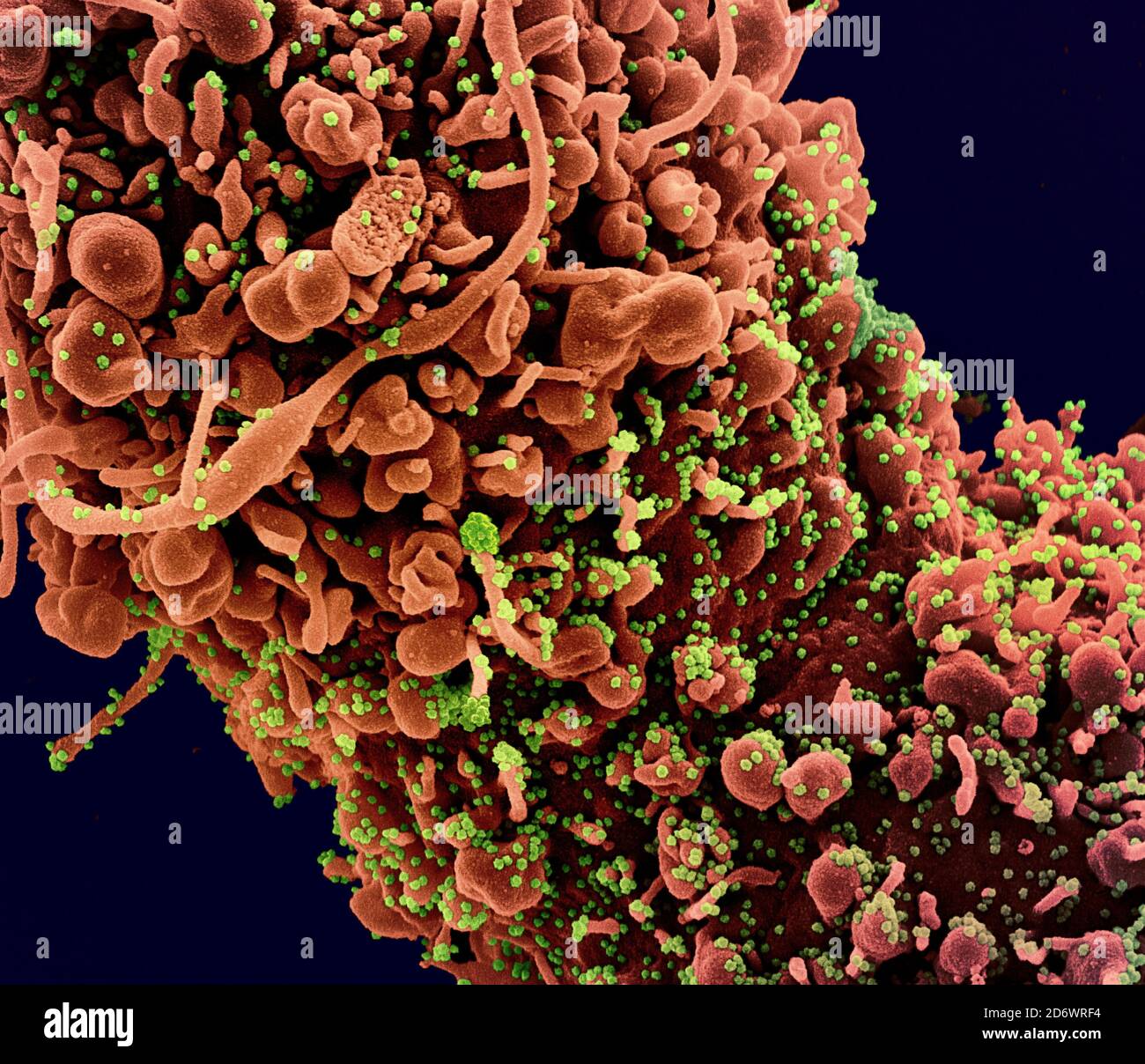 Colorized scanning electron micrograph of a cell showing morphological signs of apoptosis, infected with SARS-COV-2 virus particles (green), isolated Stock Photo