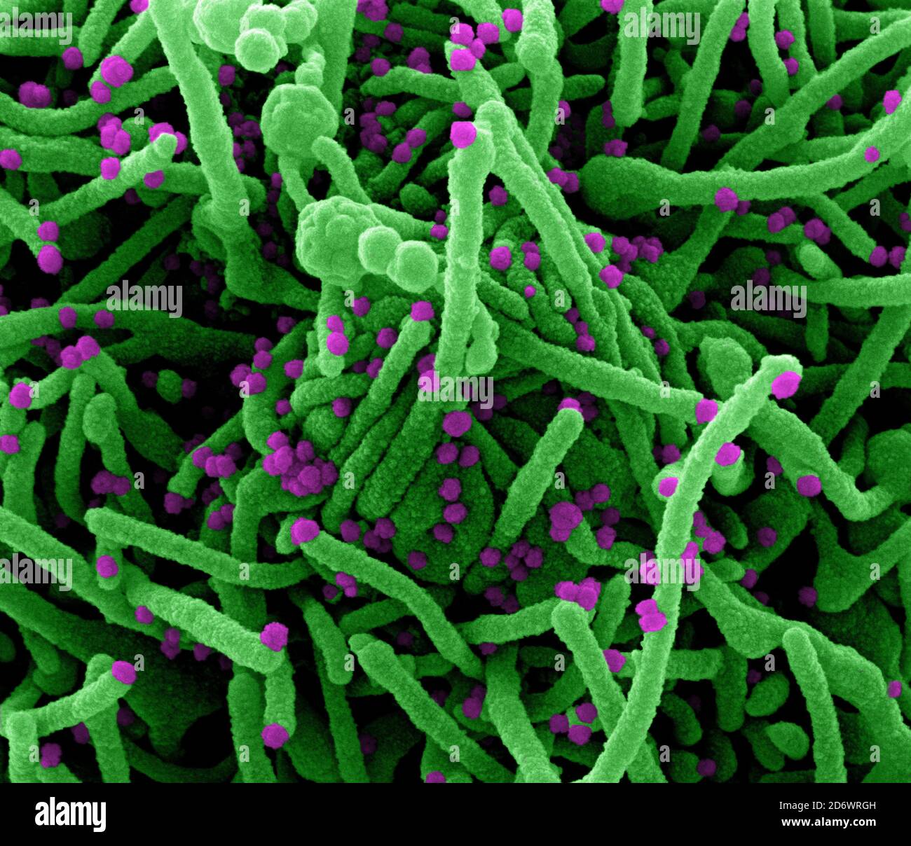 Colorized scanning electron micrograph of a cell (green) infected with SARS-COV-2 virus particles (purple), isolated from a patient sample. Image capt Stock Photo