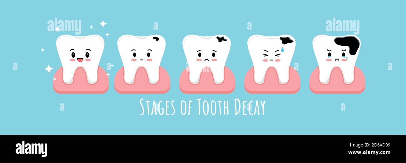 Stages of tooth decay in gum icon set. Stock Vector