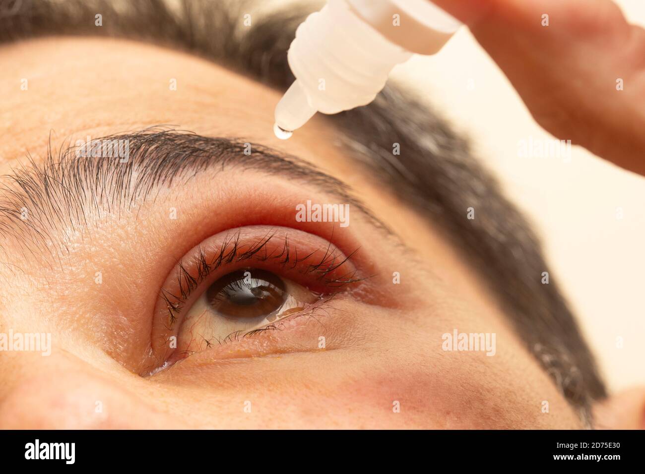Hand placing drops of eye drops in inflamed eye with infected stye, upper eyelid, ophthalmic
