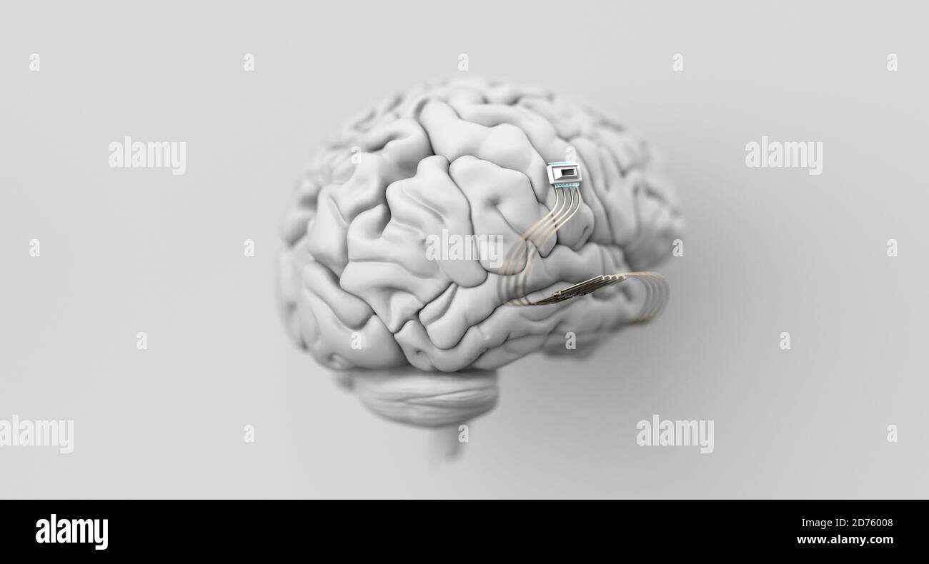 Neurotechnology, implantable brain machine, chip inserted into brain. Stock Photo