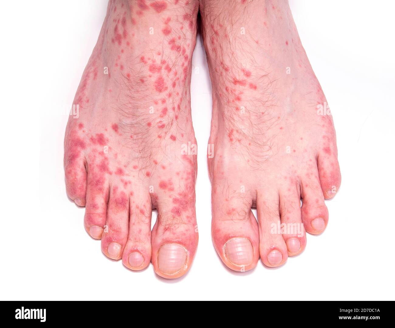 Skin disorder as hives. Human legs with rash isolated on white. Stock Photo