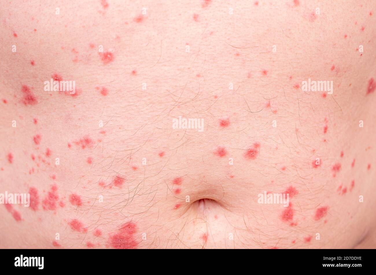 Close-up of skin disorder as hives or allergy. Human body with rash Stock Photo