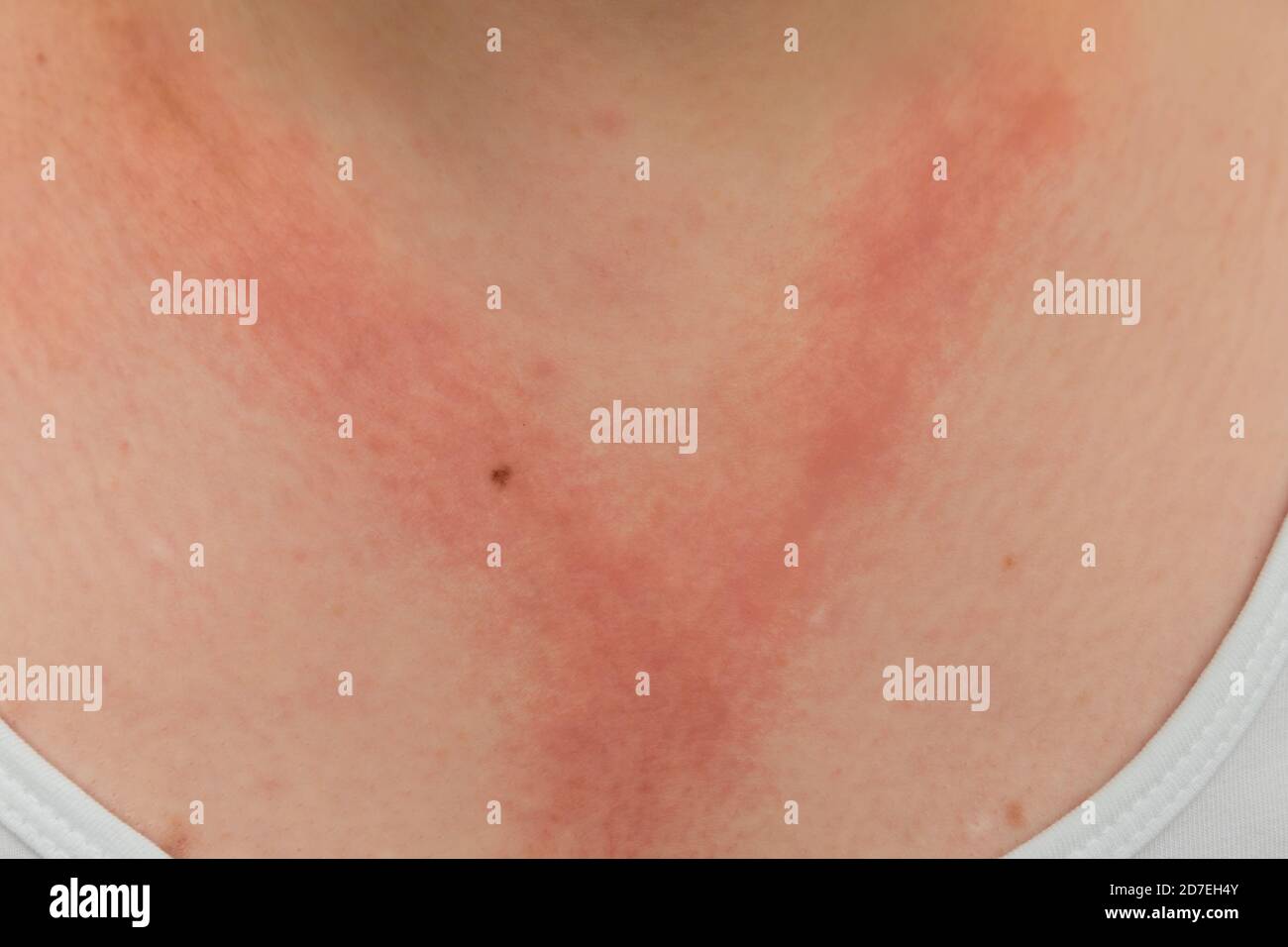 A white lady with allergic contact dermatitis red rash on chest and neck from reaction to nickel jewellery necklace Stock Photo