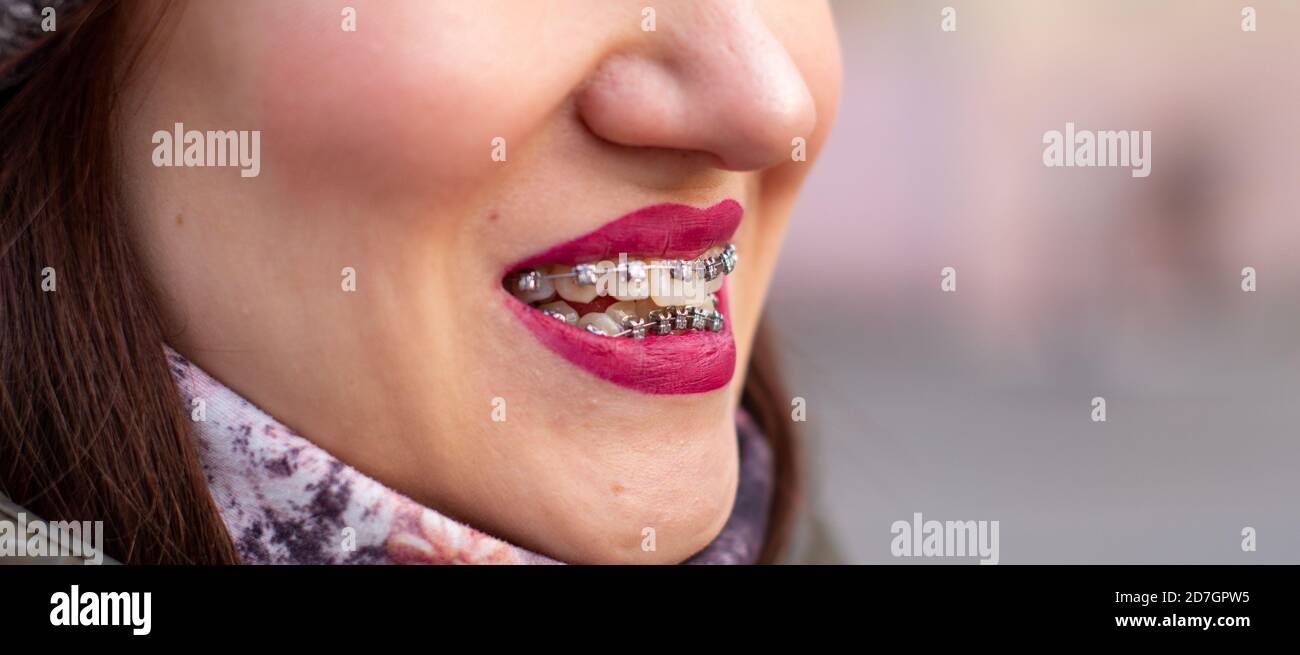 The brace system in the girl's smiling mouth, closeup of red lips