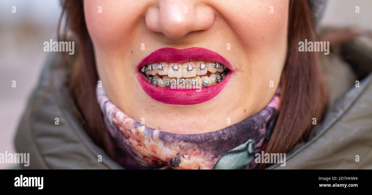 The brace system in the girl's smiling mouth, close-up of red lips Stock Photo