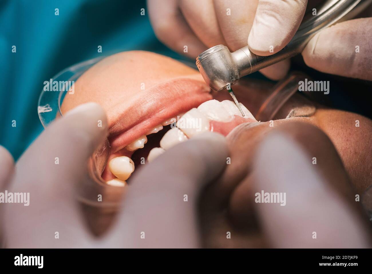 Mouth of female patient during orthodontic procedure Stock Photo