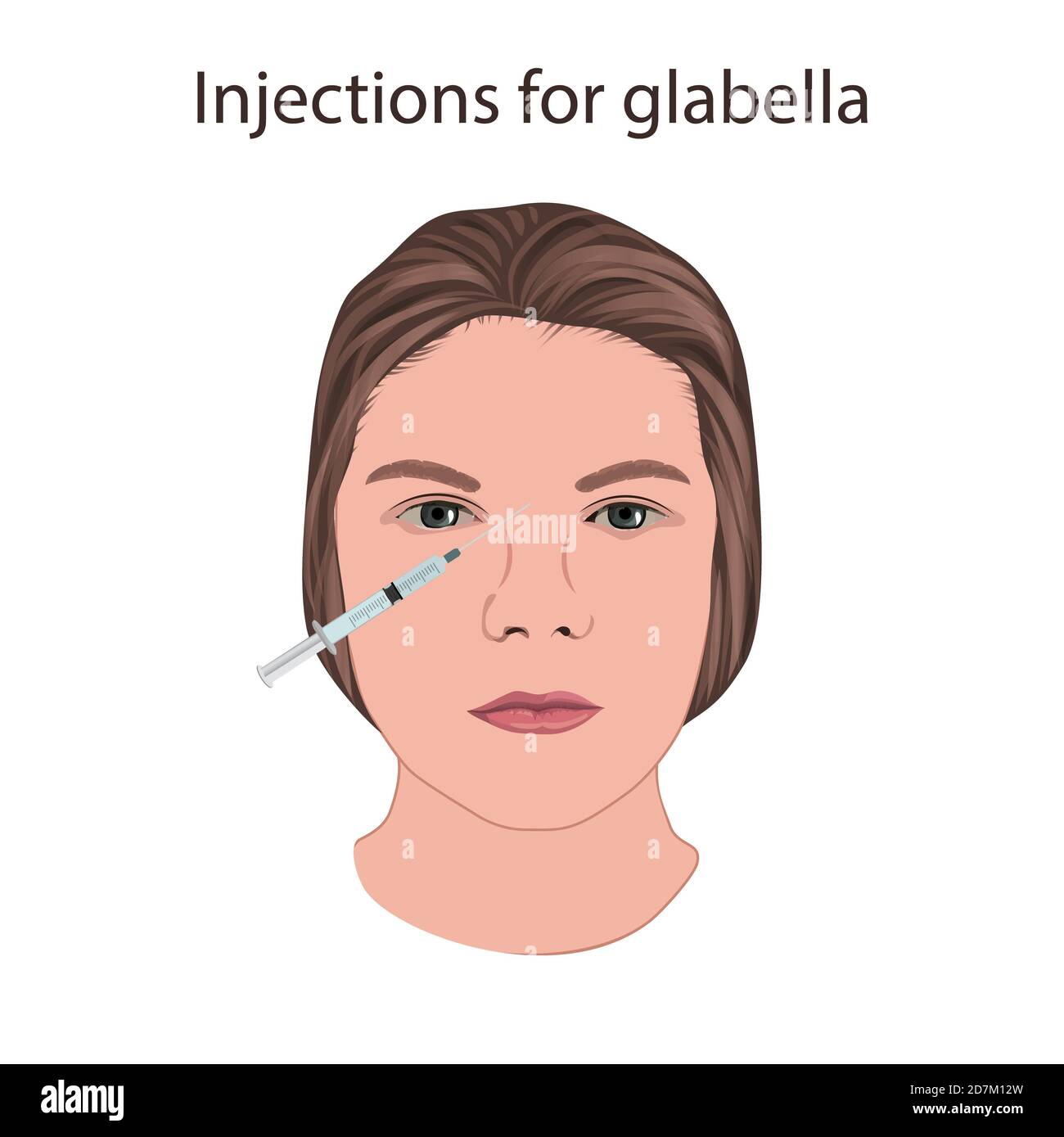 Injections for glabella, illustration. Stock Photo