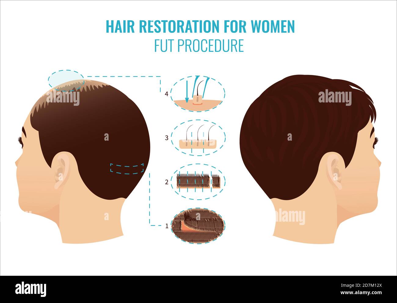 Illustration of female hair loss treatment with follicular unit extraction (FUE). Stages of FUE procedure for women. Stock Photo