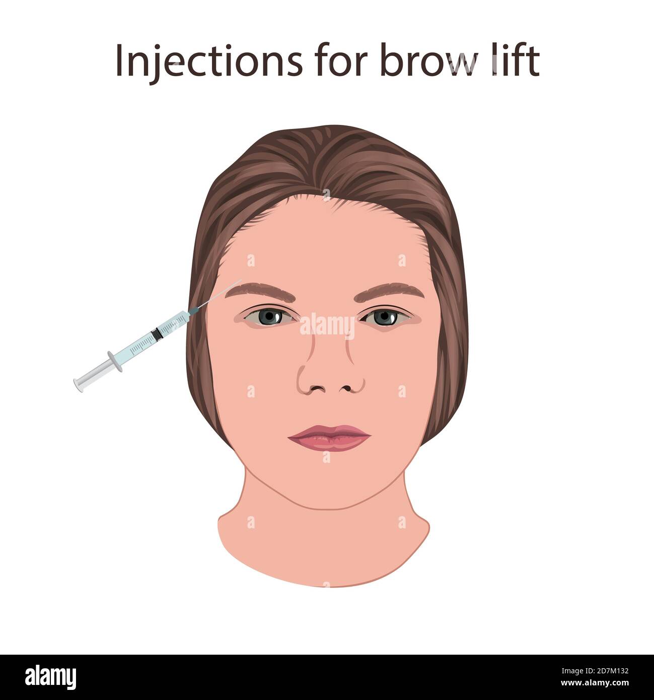 Injections for brow lift, illustration. Stock Photo