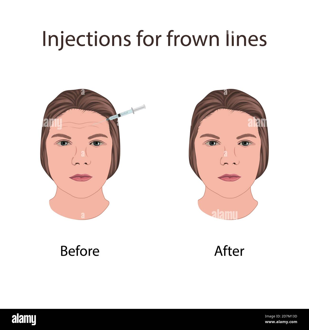 Woman's face before and after injections for frown lines, illustration