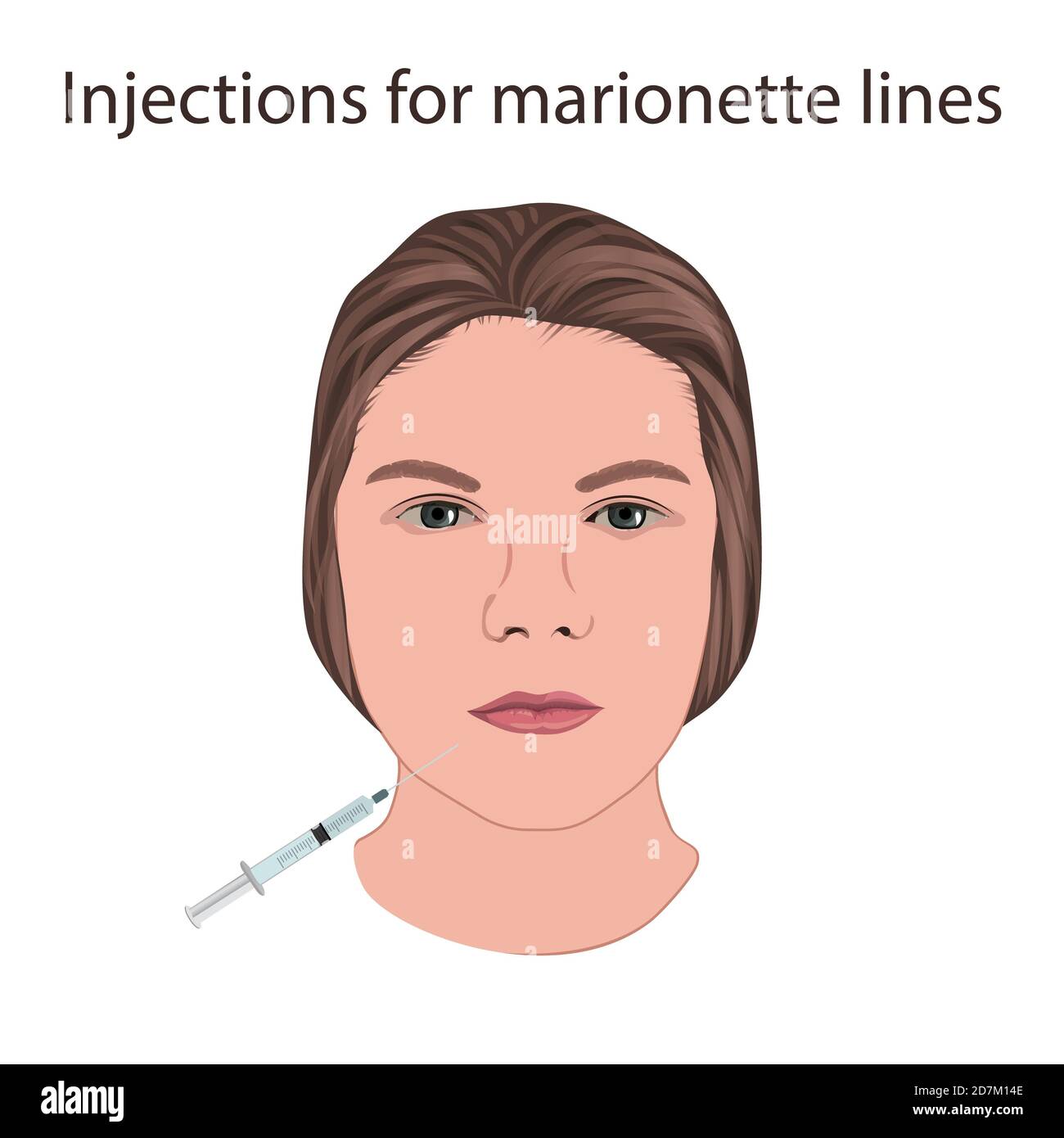 Injections for marionette lines, illustration. Stock Photo