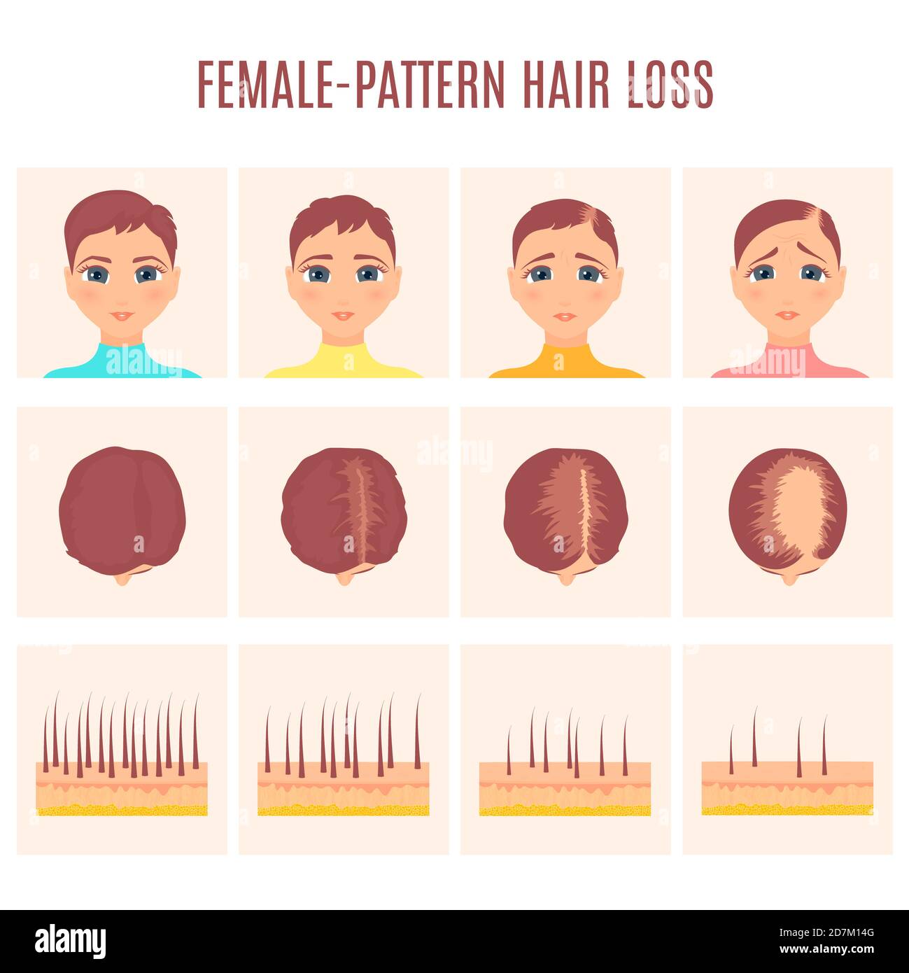 Female pattern hair loss, illustration. Stock Photo