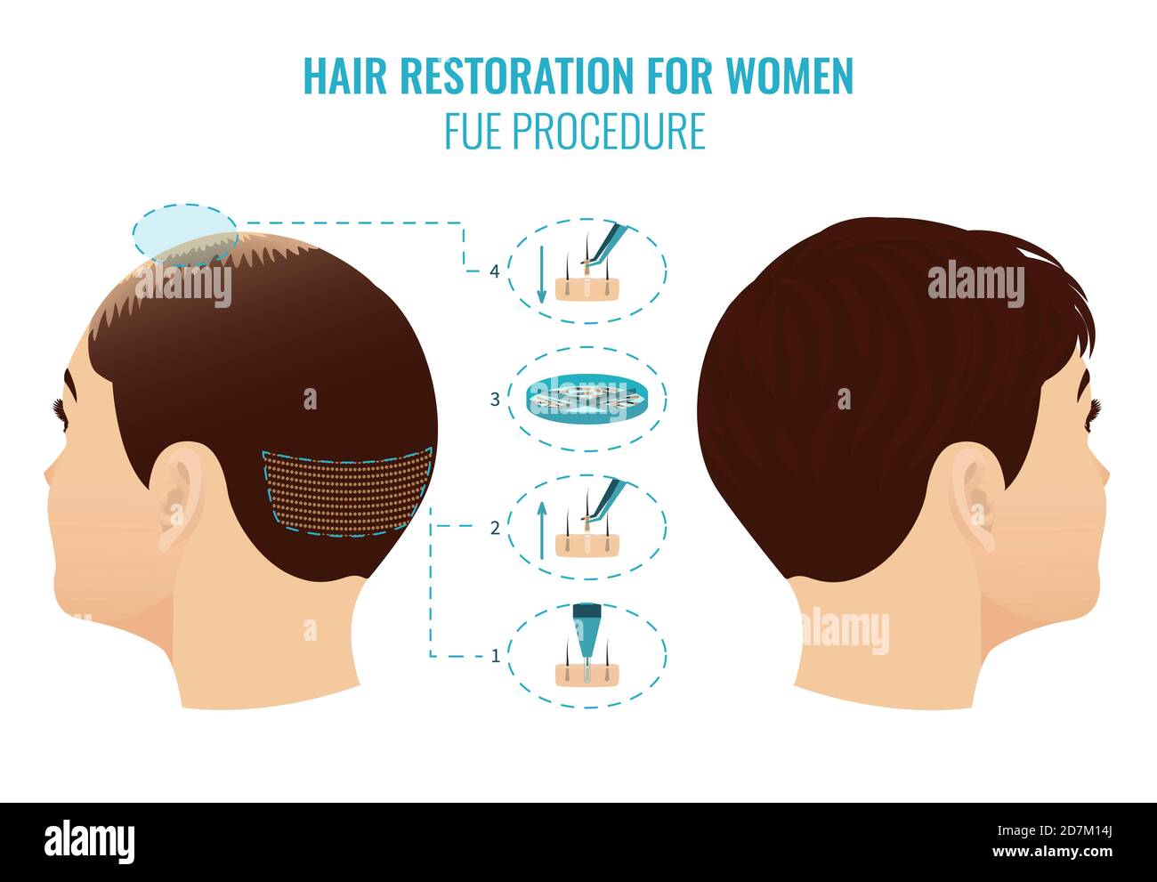 Illustration of female hair loss treatment with follicular unit extraction (FUE). Stages of FUE procedure for women. Stock Photo