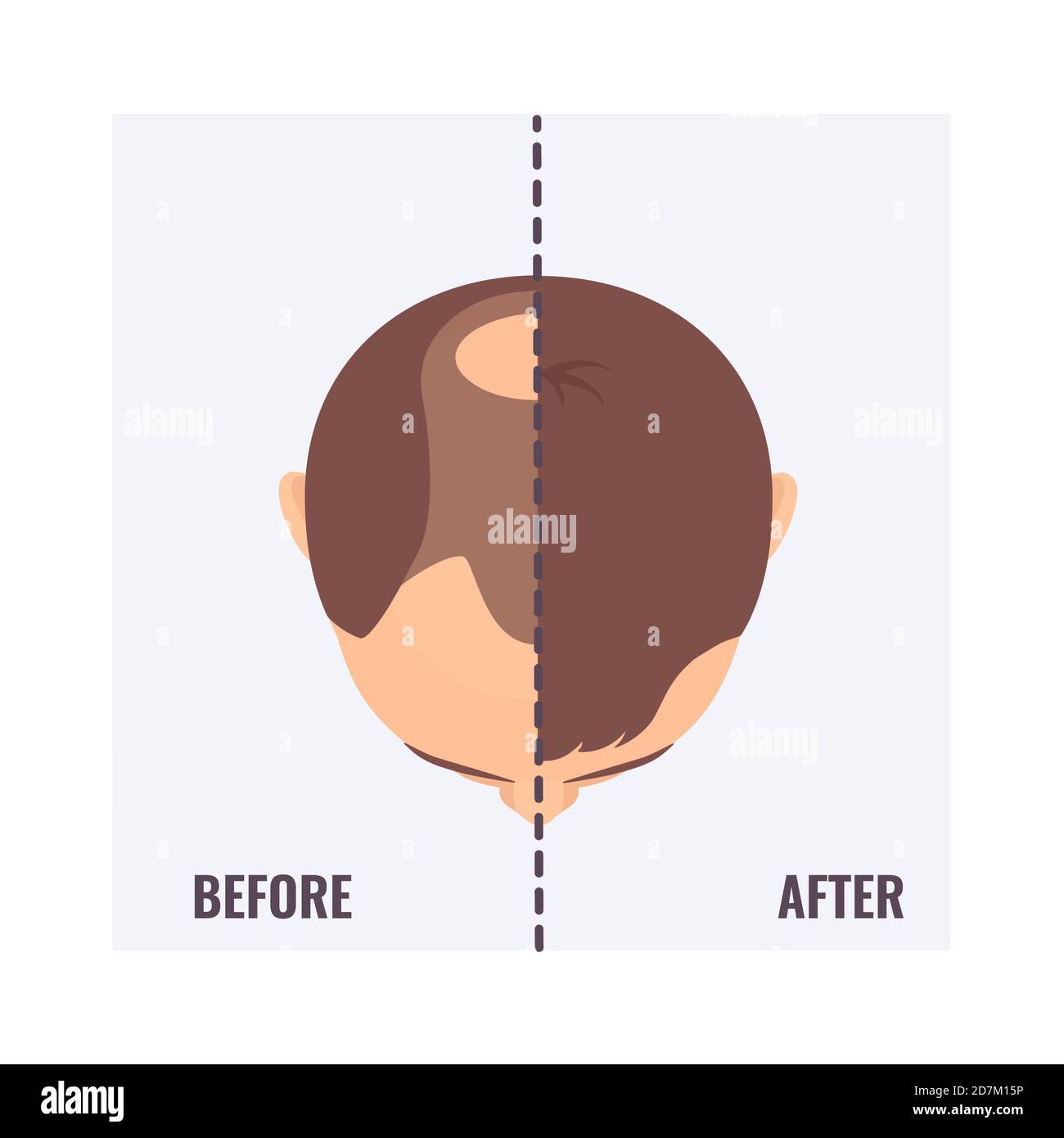 Man before and after a hair transplant, conceptual illustration. Stock Photo