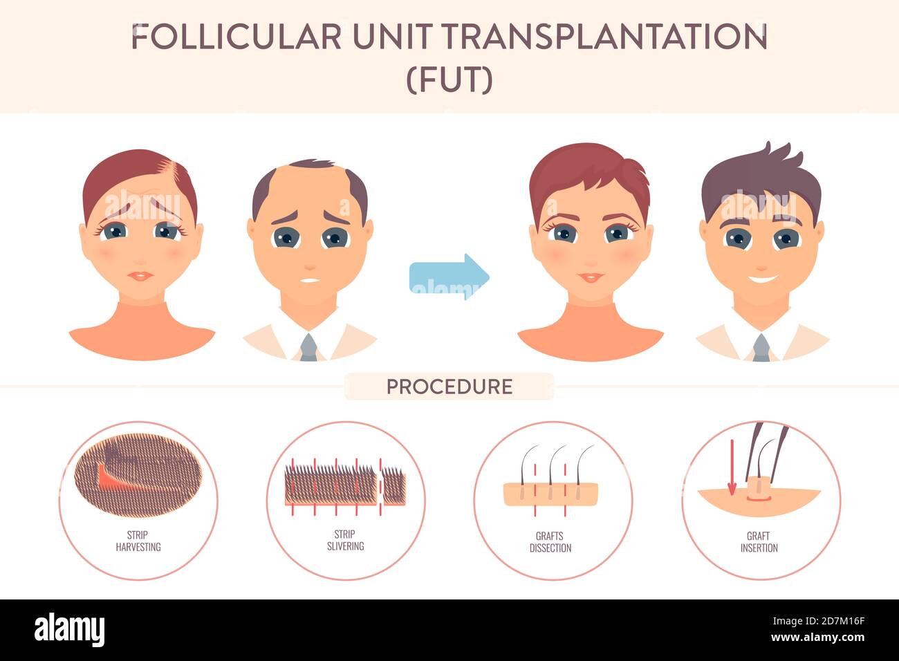 Multiple follicular unit transplant Turkey