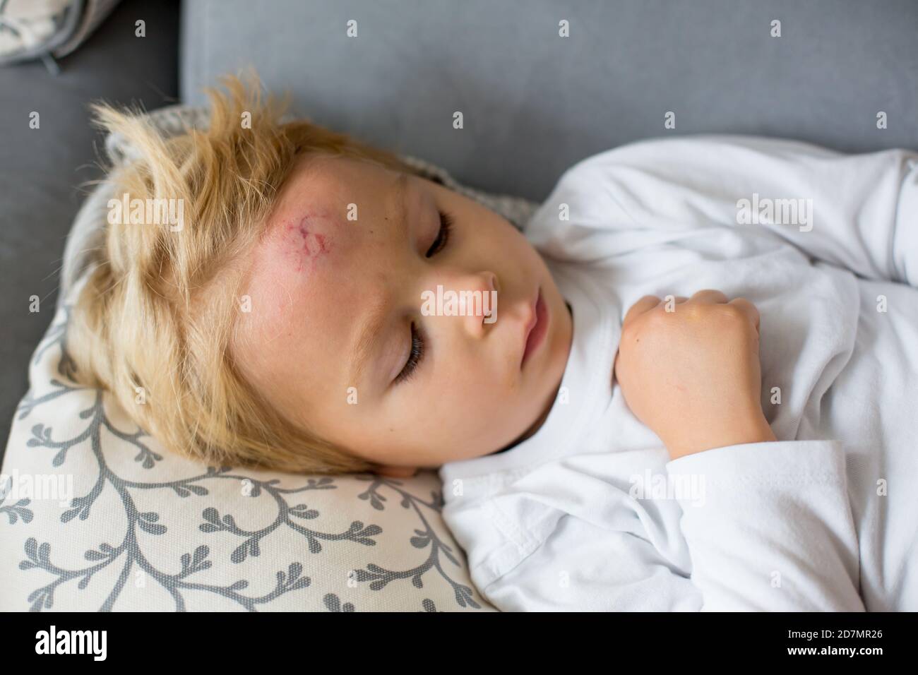 Toddler boy, lying on the couch at home with big bump on the forehead