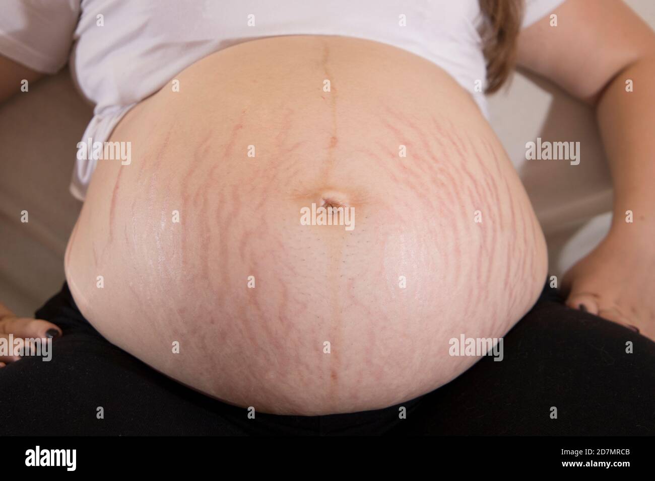Female hanging belly with stretch marks on skin closeup