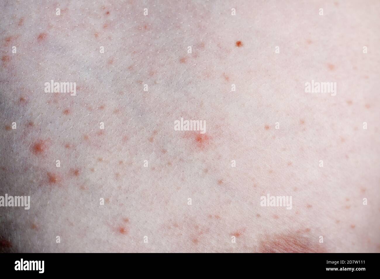 Close up image of a little boy's body suffering severe urticaria, nettle rash also called hives. Stock Photo