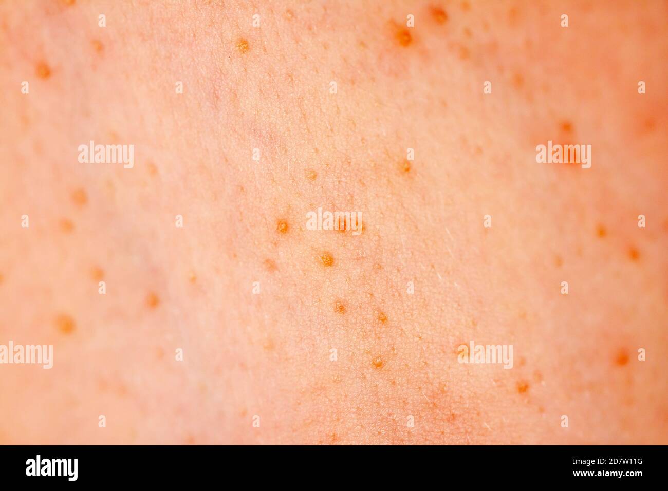 Close up image of a little boy's body suffering severe urticaria, nettle rash also called hives. Stock Photo