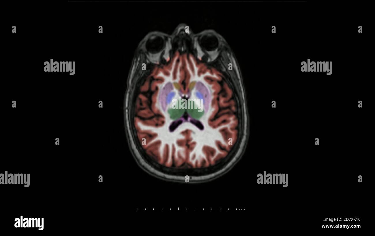 resonance imaging of the brain in axial plane color coded sequence used for diagnosis