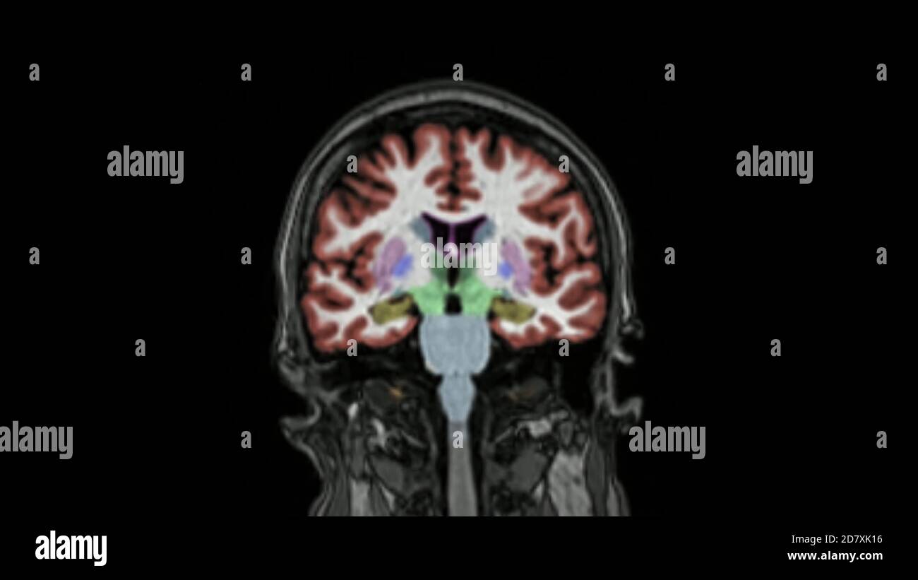 Magnetic resonance imaging of the brain in coronal plane color coded sequence used for diagnosis of memory impairment and Alzheimer disease. MRI brain Stock Photo