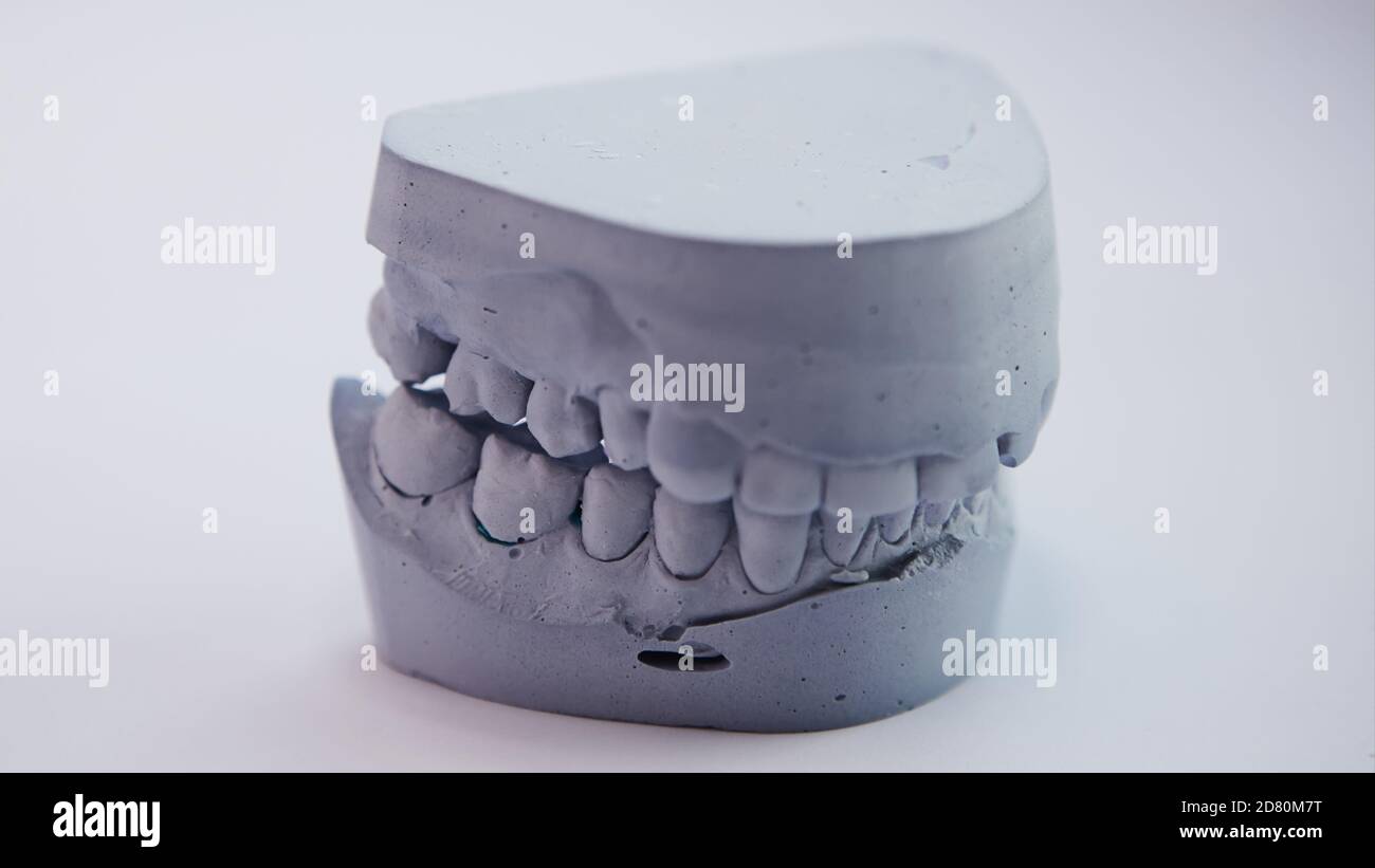 Plaster Cast Molds of the Upper and Lower Jaws Stock Image - Image of  manufacture, prosthesis: 135488427