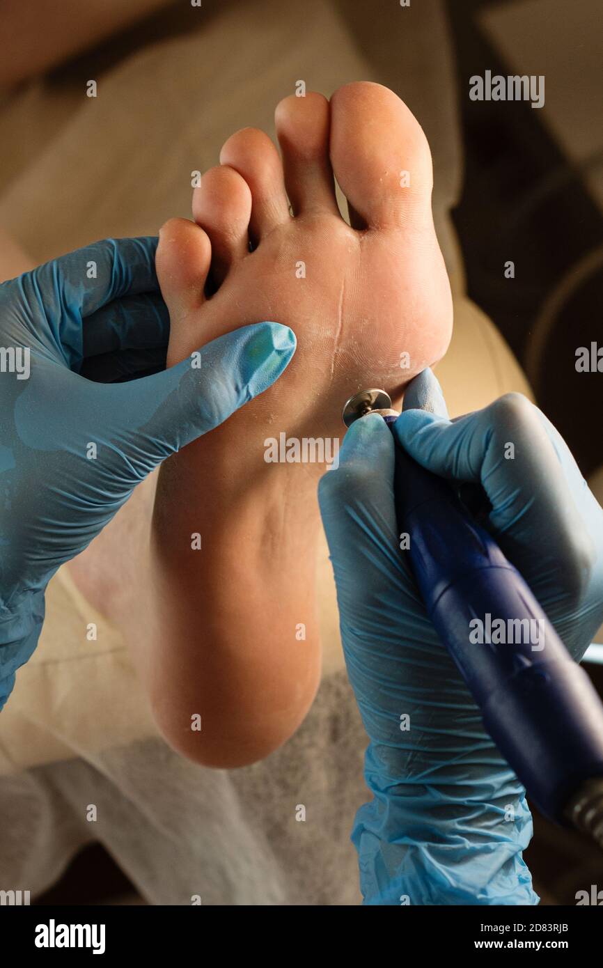 Podiatrist using grinding equipment and making procedure polish for