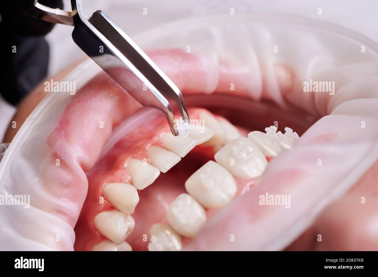 Dental cheek retractor hires stock photography and images Alamy