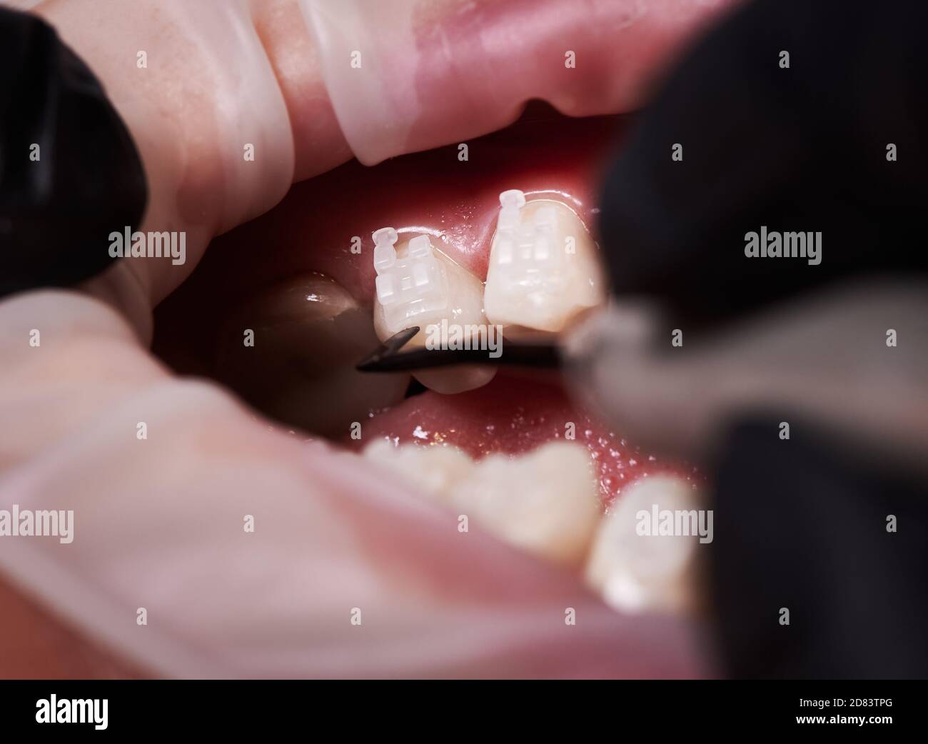 Close up of orthodontist putting orthodontic brackets on patient teeth. Person with cheek