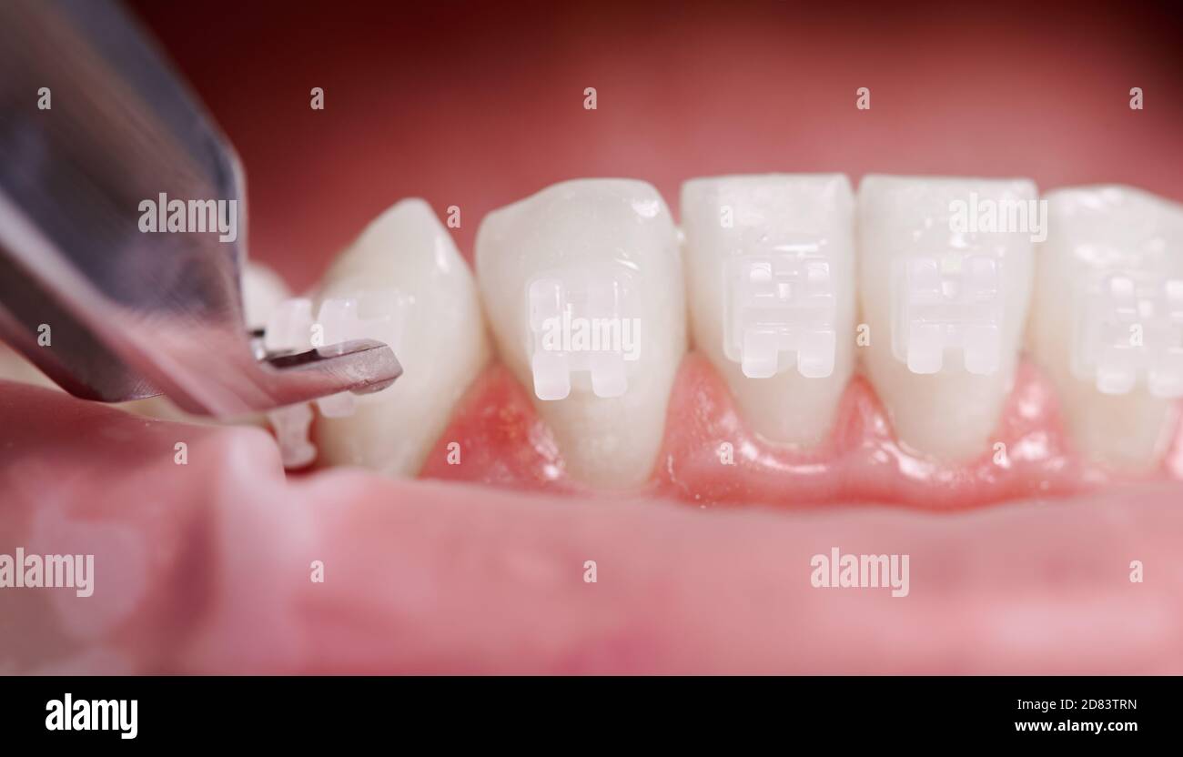 Close up of orthodontist attaching orthodontic brackets on patient