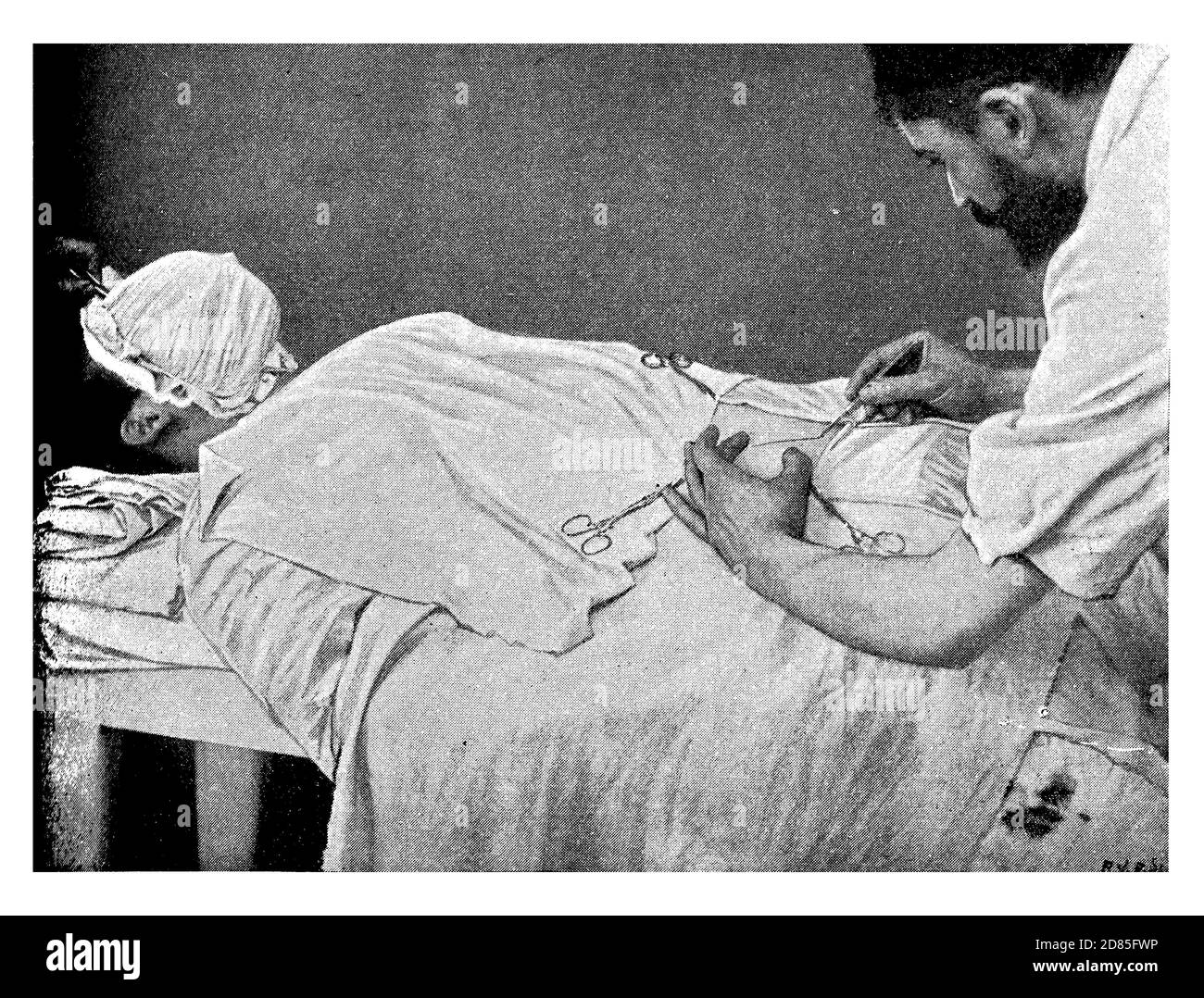 Healthcare and medicine vintage illustration: surgical removal of the appendix with an open incision in the abdomen (laparotomy) Stock Photo