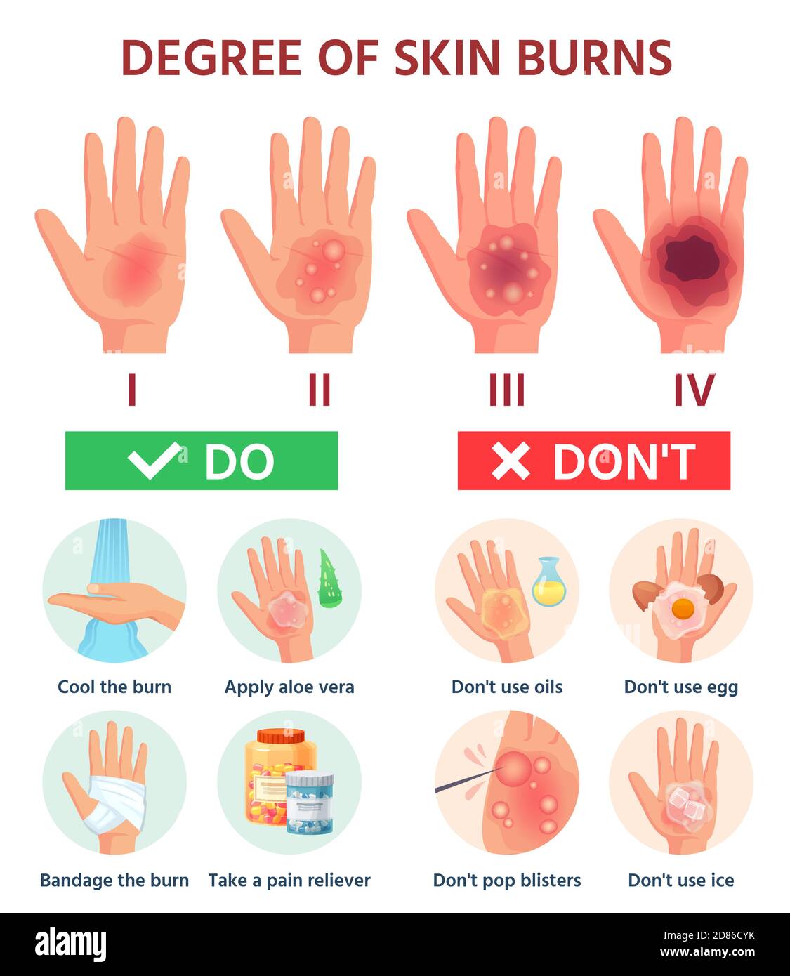 Burns degree. First aid for burn wound. Fire damage to skin classification. Hand blisters. Vector infographic treatment for thermal wound Stock Vector