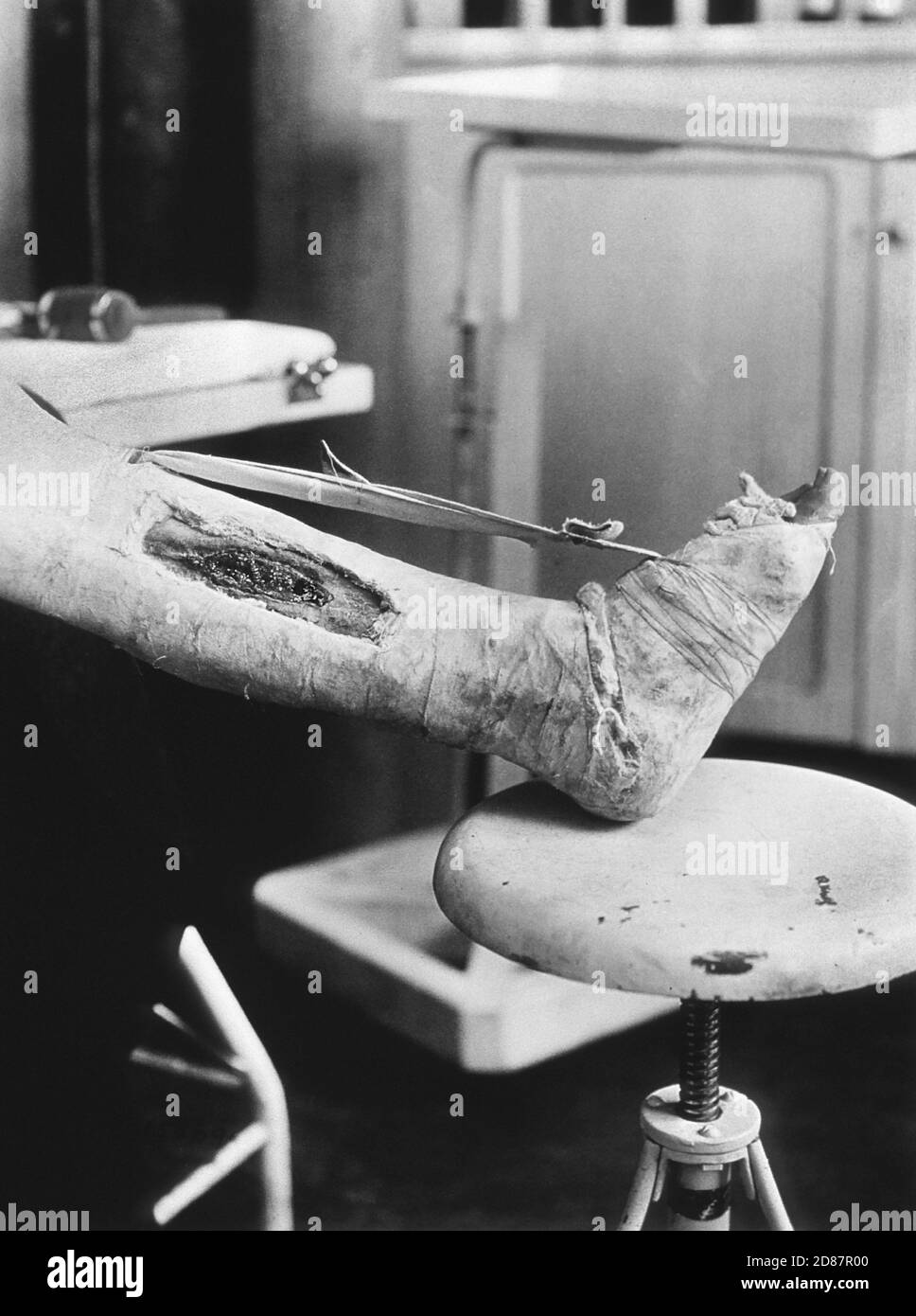 Leg Wound at Unidentified Base Hospital during World War I, France, U.S. Army Signal Corps, 1914-1918 Stock Photo