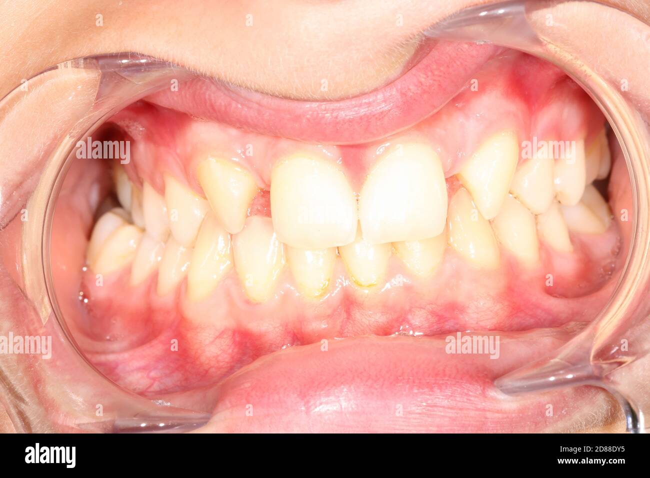 Intraoral picture of teeth and gum in the smile mouth oral care