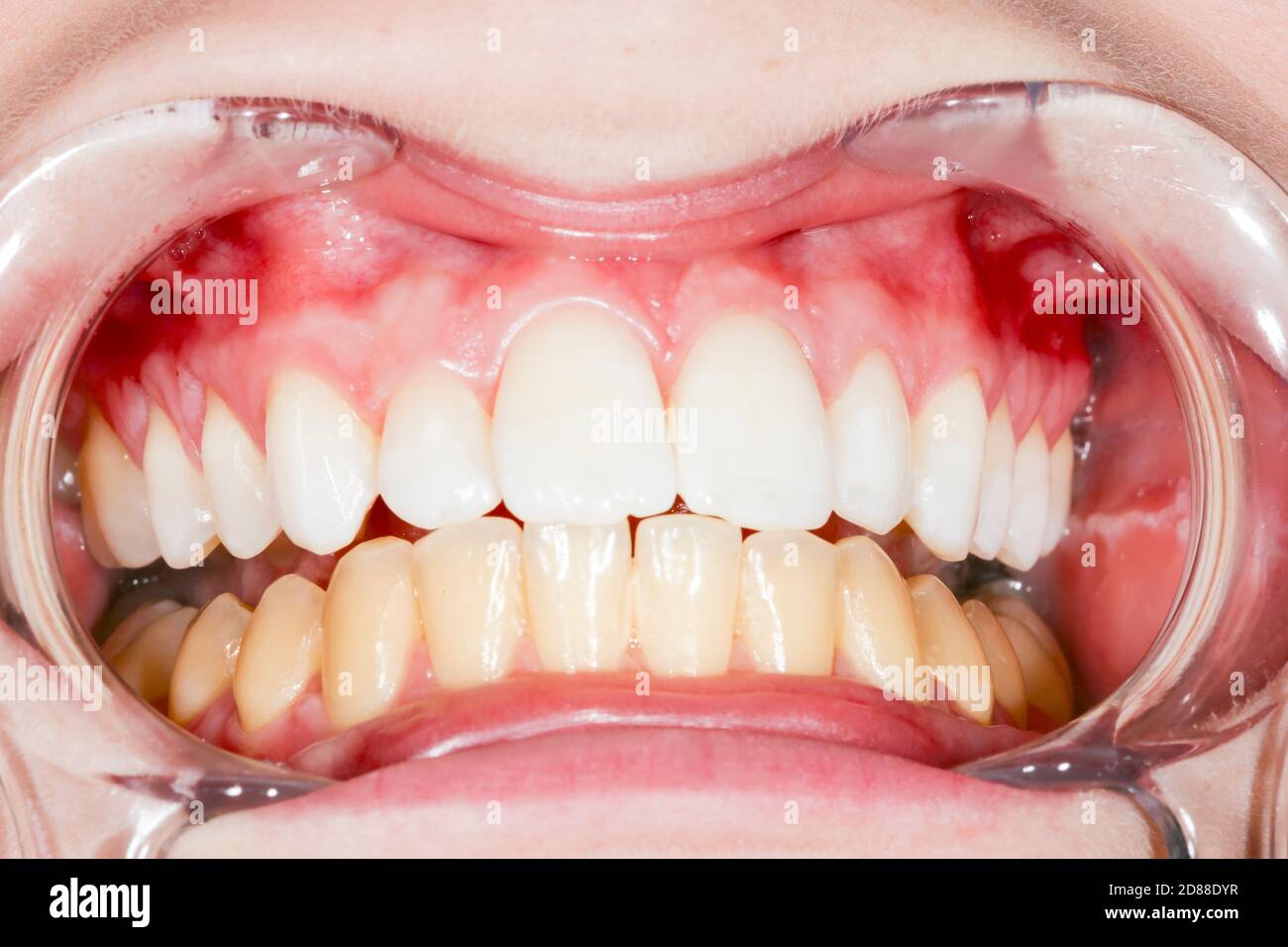 Before and after teeth bleaching or whitening treatment. Close-up of young Caucasian female with mouth opener at dental office Stock Photo