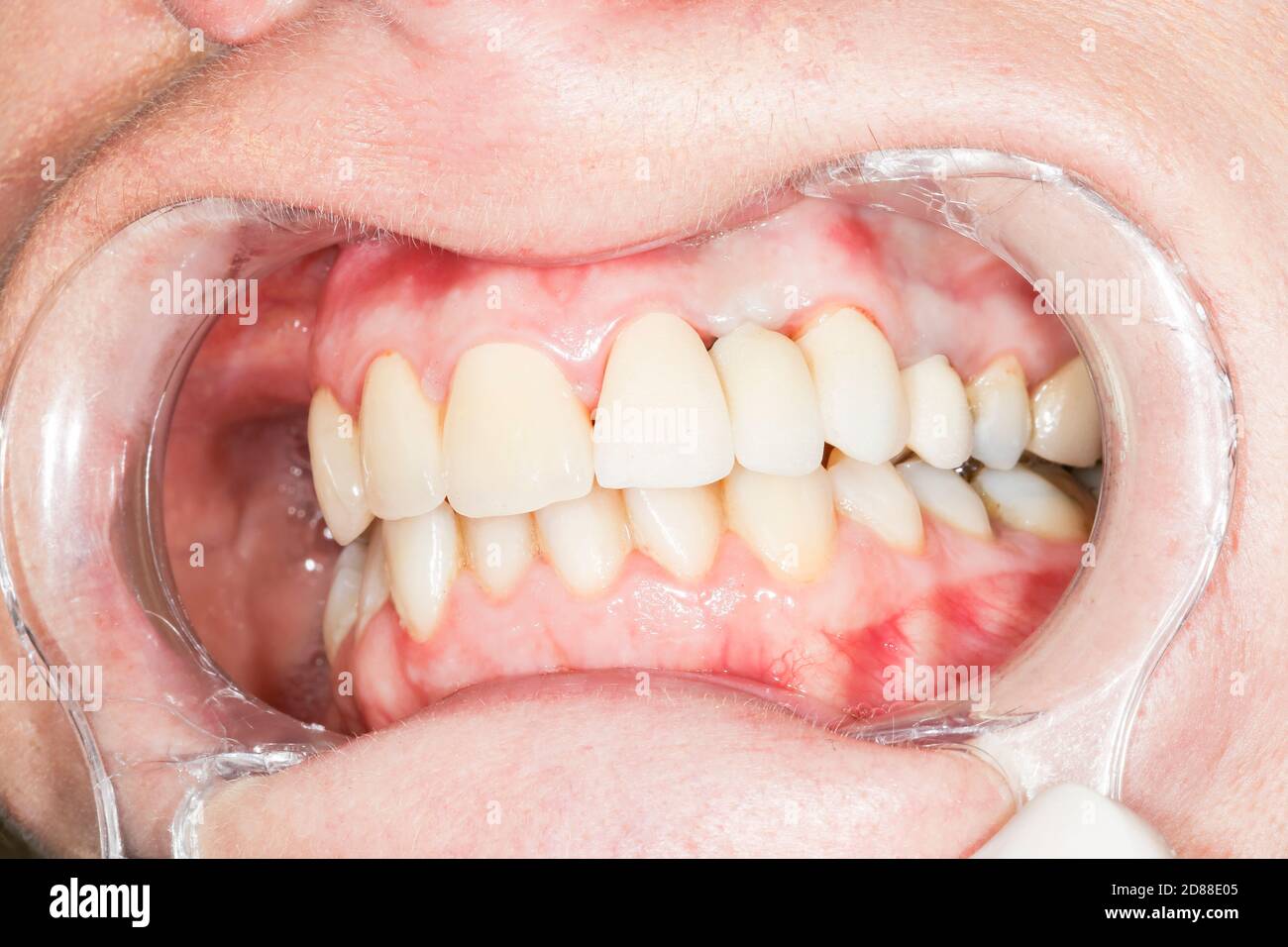 Gold filling teeth hires stock photography and images Alamy