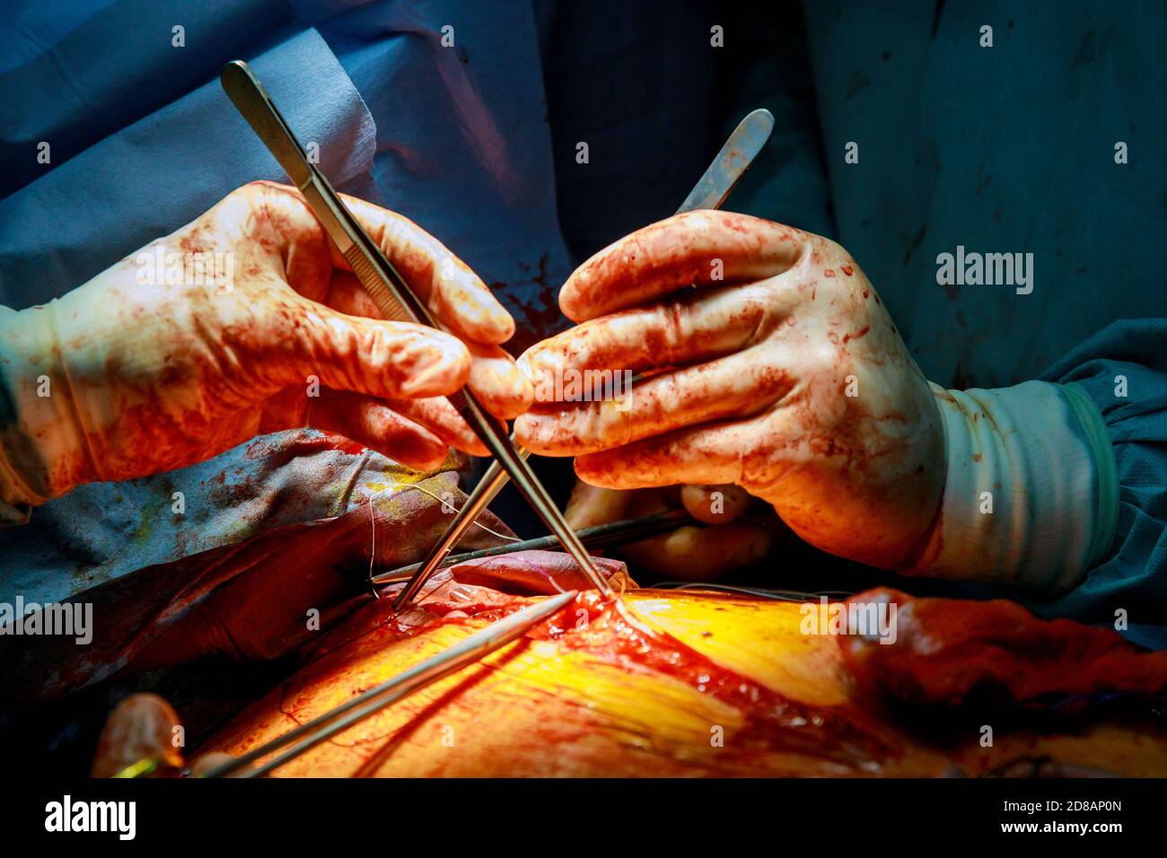 The hands of surgeon is stitching a wound after an operation in a hospital Stock Photo