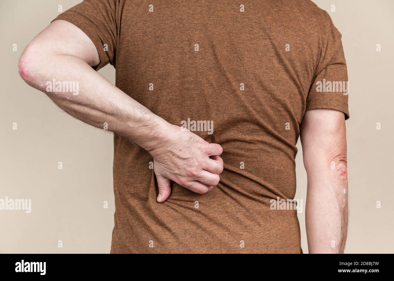 Back psoriasis. Man hands scratching the itch on the back. Concept of